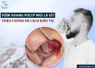 Viêm xoang Polyp mũi là gì? Triệu chứng và cách điều trị hiệu quả